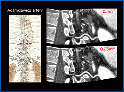 図5　Aquilion PrecisionによるAdamkiewicz動脈の描出