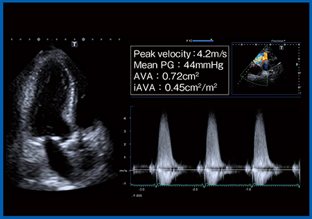 図1　症例：経胸壁心エコー