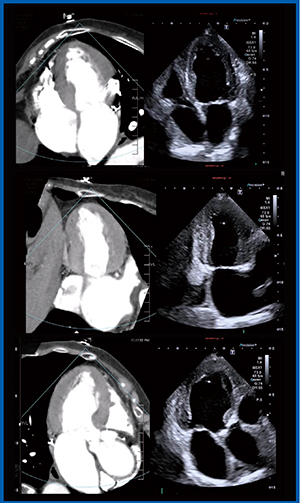 図4　心尖部像の描出におけるFusion Imagingの教育的効果 上段：四腔像，中段：二腔像，下段：三腔像