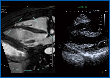 図8　MRIと超音波のFusion Imaging