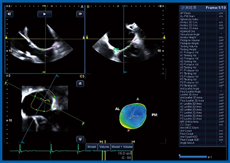 図10　僧帽弁解析ソフトウエアの画面