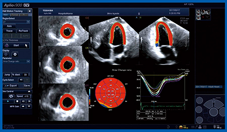 図1　左室の3D-WMTのAuto-tracking解析