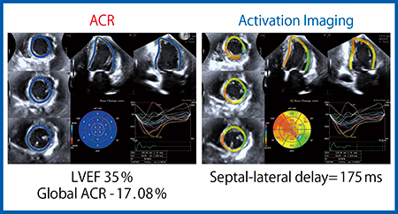 図4　拡張型心筋症症例におけるActivation Imagingによるdyssynchronyの評価