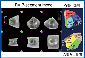 図5　右室専用のストレイン解析ソフトウエアによる3D-WMT解析結果