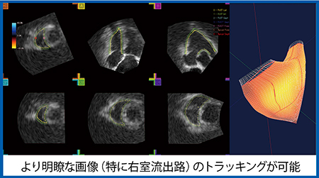 図8　3D TEEによる3D-WMT解析結果（W.I.P.）（画像ご提供：筑波大学・石津智子先生）