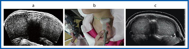 図1　びまん性甲状腺疾患に対するパノラミックビュー a：水囊で検査した過去画像　b：プローブを平行移動して撮像　c：パノラミックビュー（横断面）