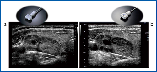 図3　Bモードによる充実性腫瘍の描出能の比較（12MHz） a：Aplio 500　b：Aplio i800