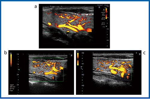 図4　超音波診断装置の進化：パワードプラ法（12MHz） a：Aplio i800　b：Aplio XG　c：Aplio 500