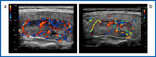 図6　超音波診断装置の進化：カラードプラ法 a：Aplio 500　b：Aplio i800