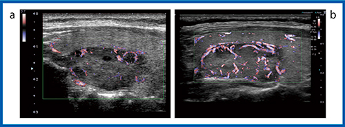 図8　cSMIによる充実性腫瘍の描出能の比較（12MHz） a：Aplio 500　b：Aplio i800