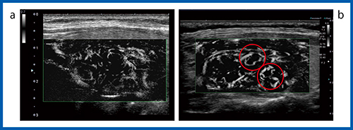 図9　mSMIによる充実性腫瘍の描出能の比較（12MHz） a：Aplio 500　b：Aplio i800
