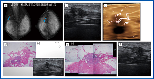 図1　症例1 a：マンモグラフィ画像　b：Bモード画像　c：Smart 3DによるSMI画像　d：病理像とBモード画像の対比　e：病理像　f：eのBモード画像