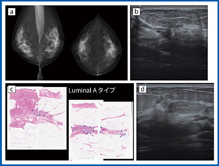 図4　症例4：硬癌 a：マンモグラフィ画像　b：Bモード画像　c：病理像　d：Bモード画像