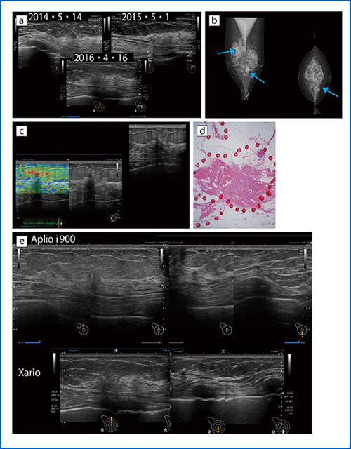 図5　症例5：非浸潤性小葉癌と硬化性腺症に伴うDCIS a：過去3年の検診画像　b：マンモグラフィ画像　c：エラストグラフィ画像　d：病理像　e：Xario（下）とAplio i900（上）の比較