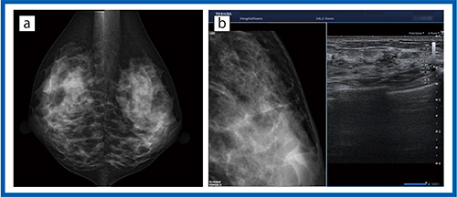図6　症例6：石灰化症例 a：マンモグラフィ画像　b：リファレンス表示