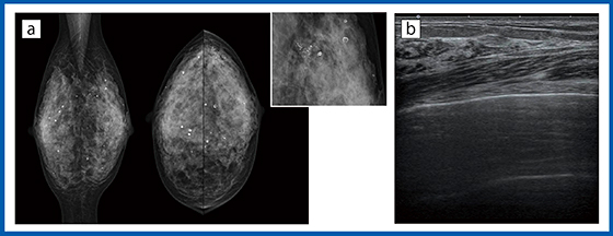 図7　症例7：石灰化症例 a：マンモグラフィ画像　b：Bモード画像