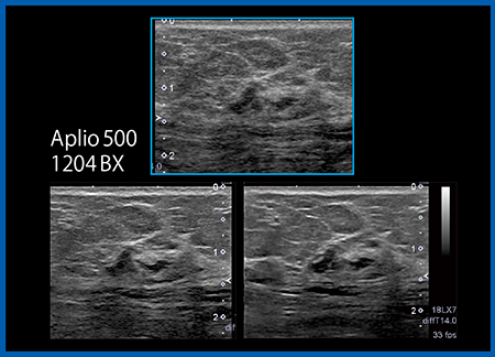 図5　乳房における画質の比較