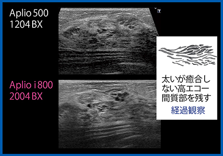 図10　乳腺症（経過観察）