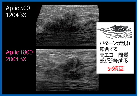 図11　コメド型の非浸潤性乳管癌（要精査）