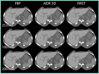 図3　FBP，AIDR 3D，FIRSTの線量の違いによる画質の比較