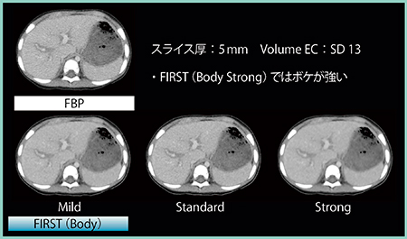 図5　FBPとFIRST Bodyの画質の比較（図4と同症例）