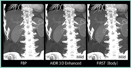 図6　FIRSTにおけるCTAの画質向上（肺血管・腹部血管）：MIP画像