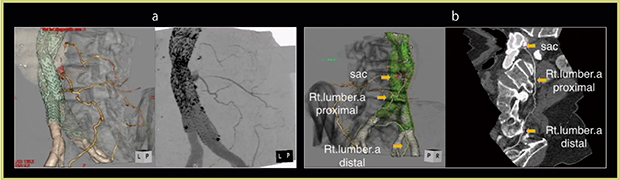 図2　典型的なtypeⅡ endoleak症例 a：DV-CTA VR画像（左）とMIP画像（右）　b：DV-CTA curved MPR画像