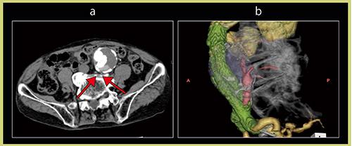 図4　TypeⅠb endoleak症例 a：CTA アキシャル画像　b：DV-CTA画像