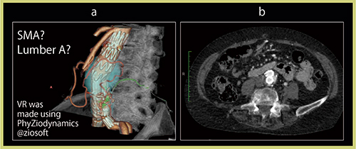 図6　TypeⅡ endoleakの原因血管の鑑別 a：DV-CTA画像　b：DV-CTA アキシャル画像