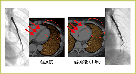 図6　CTA画像とLung Iodine MAPの治療効果判定2）