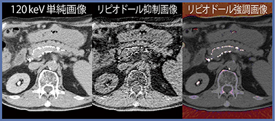 図2　症例2：HCCのTACE後のリピオドール弁別解析