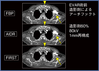 図1　症例1：EVAR術前