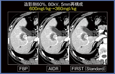 図8　FIRSTと従来法との比較：胆管細胞がん術前