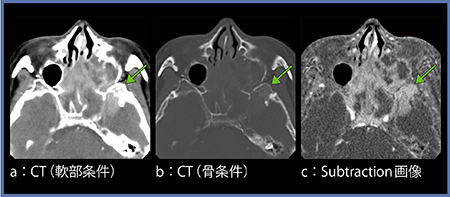 図3　Subtraction画像での頭蓋底骨浸潤・頭蓋内進展の評価