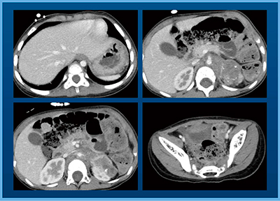 図4　症例1：左副腎原発神経芽腫化学療法後症例（2歳，女児）