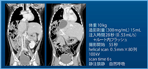 図5　症例2：肝芽腫術後・化学療法後（2歳，女児）