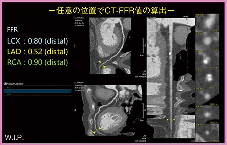 図4　流体構造連成解析によるCT-FFR計算結果（W.I.P.）