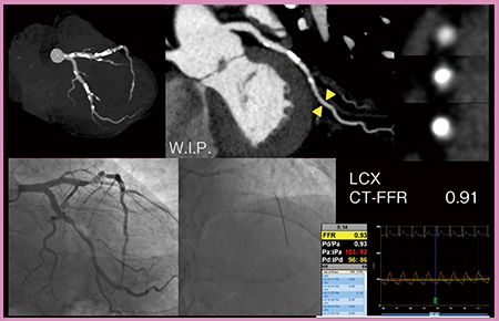 図6　症例4のLCXのカテーテルFFRとCT-FFR（W.I.P.）
