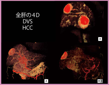 図3　全肝Dynamic Volume Scan：HCC症例