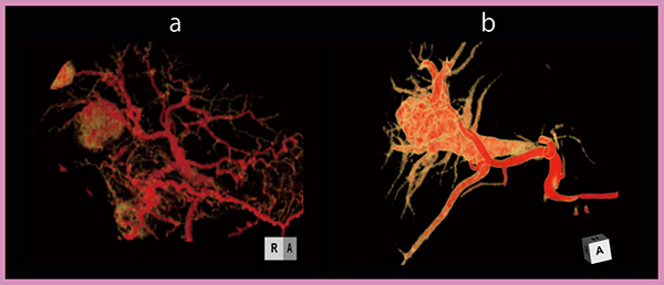 図4　全肝Dynamic Volume Scan：HCC（a）とAPシャント/門脈瘤（b）の比較