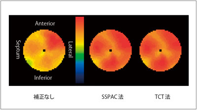 図4　外部線源法（TCT法）との比較（99mTc-tetrofosminでの正常例） （データご提供：藤田保健衛生大学様，三重大学様）