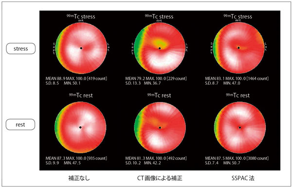 図5　SPECT/CTのCT画像を使った減弱補正とSSPAC法による減弱補正の比較（データご提供：金沢大学様）