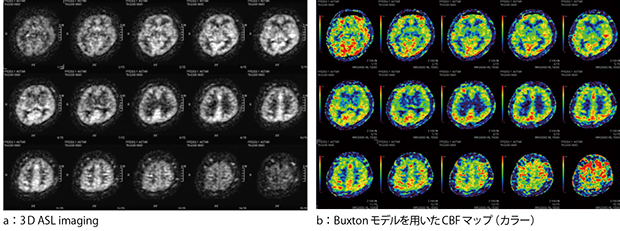図2　Buxtonモデルを用いたASLの定量化