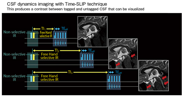 図3　CSF dynamics imagingの概念