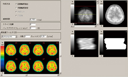 図5　均一減弱マップ作成のための前処理フィルタ（画像ご提供：国立循環器病研究センター様）