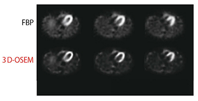 図8　3D-OSEM再構成による位置分解能・コントラスト向上（画像ご提供：国立循環器病研究センター様）