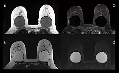 図1　シリコンインプラント画像 a：T1WI，b：脂肪抑制T2WI， c：PASTA-Si，d：脂肪抑制PASTA-Si