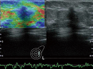 図3　Strain elastography