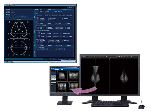 図2　マンモグラフィ読影サポート機能