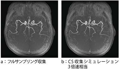 図6　CSを頭部MRAに適応した例 MRAの場合，大きな画質劣化なしに倍速率を高められることが確認できた。